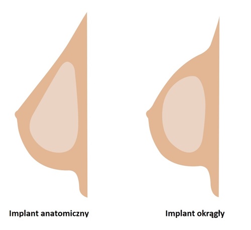 implant piersi po mastektomii